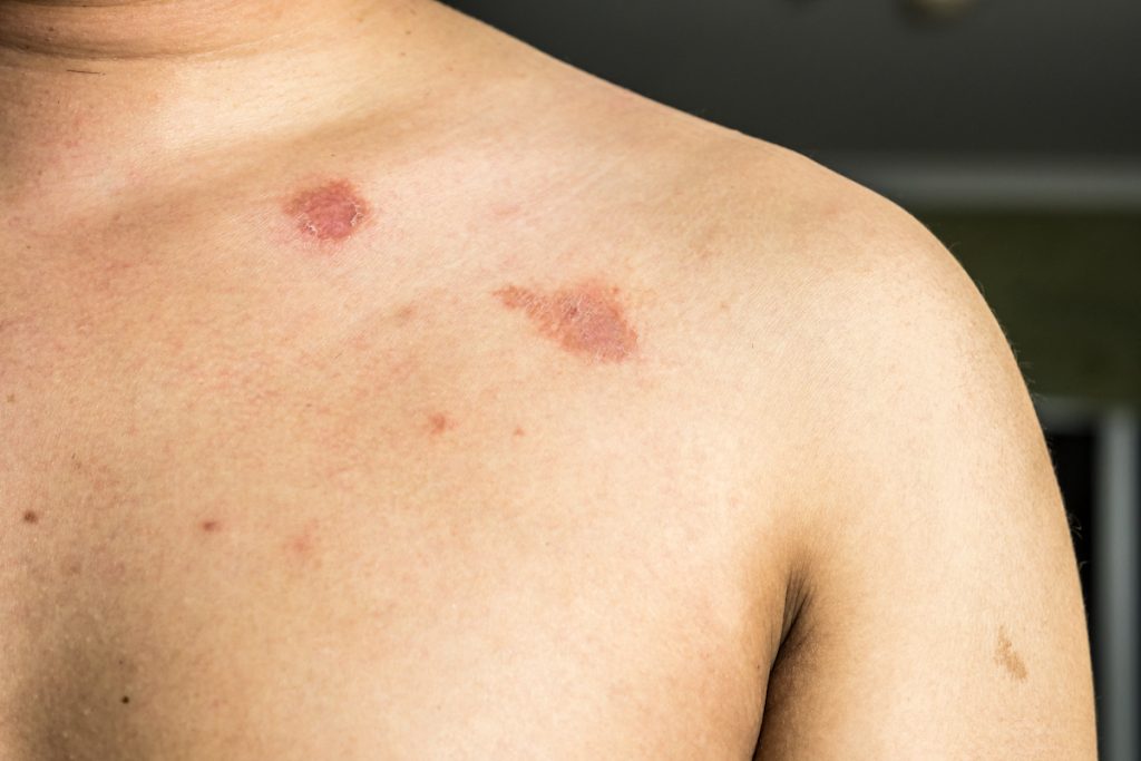 Gusano anular |:  Las peores enfermedades que puedes contraer en un gimnasio sucio |  Zestradar